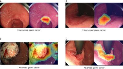 A Novel Model Based on Deep Convolutional Neural Network Improves Diagnostic Accuracy of Intramucosal Gastric Cancer (With Video)